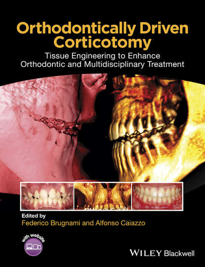 стоматология Orthodontically Driven Corticotomy