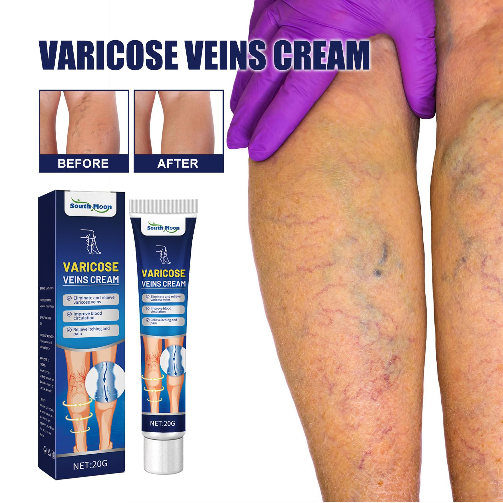 Паста Venoheal Vein Ease, паста для вен и сосудистых звездочек облегчает состояние ног, улучшает кровообращение 1 Pcs